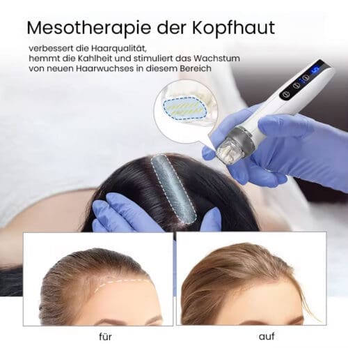Beautifly CollagenBoost Mikronadel-Mesotherapiegerät – Bild 5
